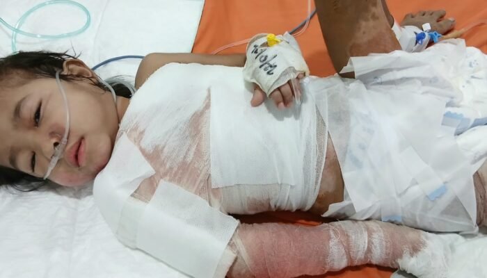 Tangis Kayla Berubah Jadi Senyum, Pasca Oprasi Kondisi Bocah Korban Luka Bakar Mulai Membaik